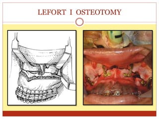 LEFORT I OSTEOTOMY
 