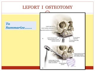 LEFORT I OSTEOTOMY
To
Summarize.......
 