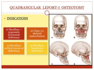 QUADRANGULAR LEFORT-I OSTEOTOMY
 INDICATIONS
1) Maxillary –
zygomatic
horizontal
deficiency
2) Class 111
skeletal
malocclusion
3) Maxillary
vertical excess or
deficiency
4) Maxillary
transverse
deficiency
 