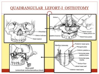 QUADRANGULAR LEFORT-I OSTEOTOMY
 