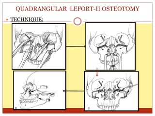 QUADRANGULAR LEFORT-II OSTEOTOMY
 TECHNIQUE:
 