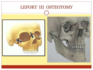 LEFORT III OSTEOTOMY
 