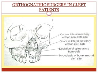 ORTHOGNATHIC SURGERY IN CLEFT
PATIENTS
 Most patients with cleft express some amount of mid face
deficiency.
 Problems due to cleft:-
 Nasal breathing
 Speech, hearing and olfaction.
 Sometimes exorbitism and eyelid in adequacy.
 