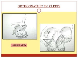 ORTHOGNATHIC IN CLEFTS
LATERAL VIEW
 