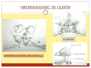 ORTHOGNATHIC IN CLEFTS
DOWNFRACTURING THE MAXILLA
CLOSURE
 