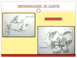 ORTHOGNATHIC IN CLEFTS
BONE GRAFTING
 