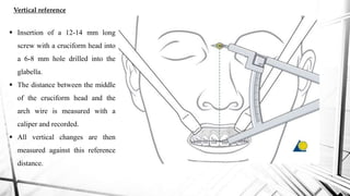 Maxillary orthognathic surgery | PPTX