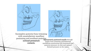 Maxillary orthognathic surgery | PPTX