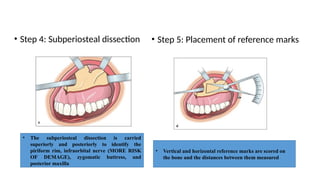 Vertical Dissection Comprehensive Guide to Maxillary Orthognathic Surgery Techniques and ...