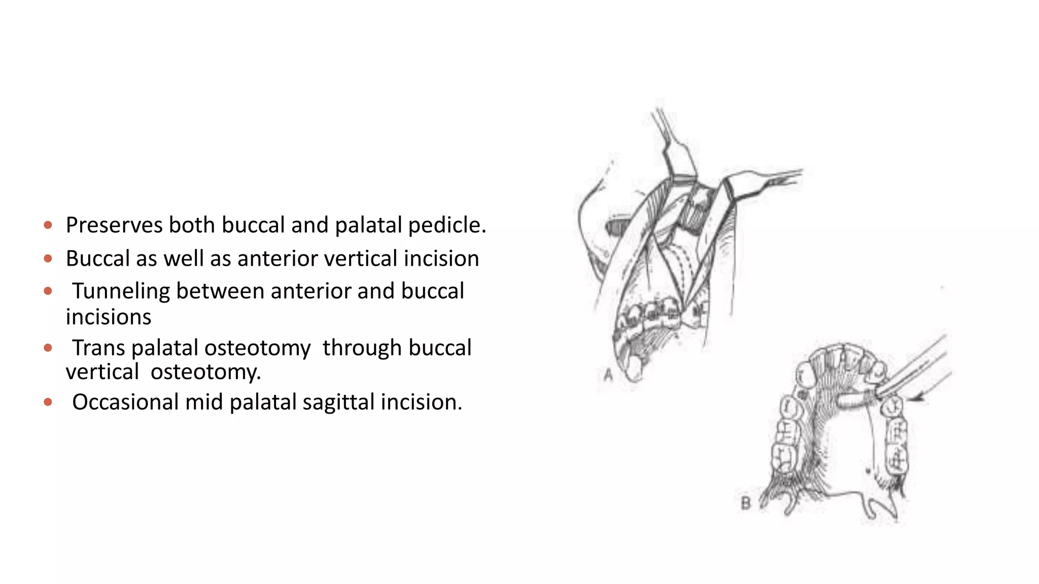 Maxillary Orthognathic Surgery | PPTX