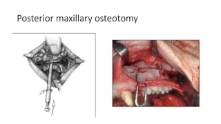 Posterior maxillary osteotomy
 