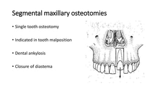Segmental maxillary osteotomies
• Single tooth osteotomy
• Indicated in tooth malposition
• Dental ankylosis
• Closure of diastema
 