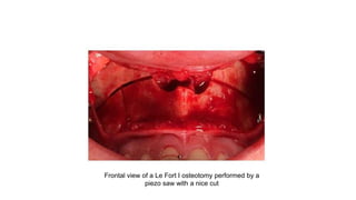 Frontal view of a Le Fort I osteotomy performed by a
piezo saw with a nice cut
 