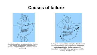 Causes of failure
•Mobilized maxilla in maxillomandibular fixation
with manual manipulation demonstrating
posterior bony interferences preventing desired
positioning
Inadequate seating with maxilla placed too forward
despite proper bone trimming because of improper
condylar positioning during fixation, with
immediate relapse following appropriate condylar
seating (Condylar sag)
 