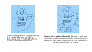 Incomplete posterior bone trimming
with unsatisfactory maxillary
positoning and resultant posterior
occlusal premature contacts
Appropriately positioned maxilla through proper bone
trimming and bimanual mandibular positioning with
downward and posterior pressure on chin and upward
forward pressure on the ramus
 
