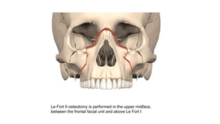 Le Fort II osteotomy is performed in the upper midface,
between the frontal facial unit and above Le Fort I
 