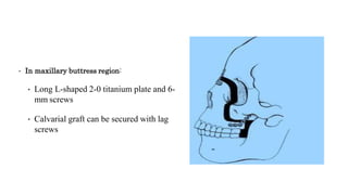• In maxillary buttress region:
• Long L-shaped 2-0 titanium plate and 6-
mm screws
• Calvarial graft can be secured with lag
screws
 