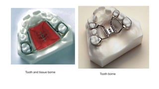 Tooth and tissue borne
Tooth borne
 
