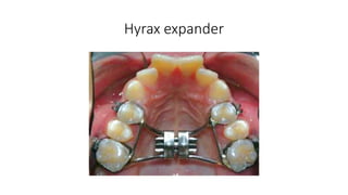 Hyrax expander
 