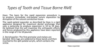 Types of Tooth and Tissue Borne RME
Haas: The basis for the rapid expansion procedure is
to produce immediate mid-palatal suture separation by
disruption of the sutural connective tissue.
The rapid palatal expander as described by Haas is a rigid
appliance designed for maximum dental anchorage that
uses a jackscrew to produce expansion in 10 to 14 days.
He believed that this will maximize the orthopedic effects
and forces produced by this appliance have been reported
in the range of 3 to 10 pounds.
2. Derichsweiler: The first premolar and molars are
banded. Wire tags are soldered to these bands and then
inserted to the split palatal acrylic, which contains the
screw.
Haas expander
 