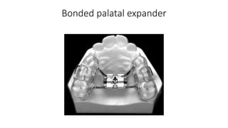 Bonded palatal expander
 