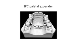 IPC palatal expander
 