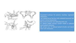 Maxillary osteotomies procedure | PPTX
