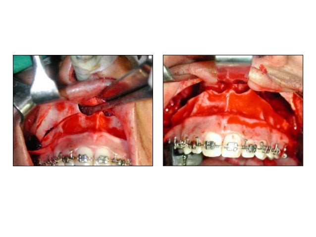 lefort osteotomies