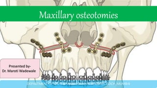 Maxillary osteotomies
Presented by-
Dr. Maroti Wadewale
DEPARTMENT OF ORAL & MAXILLOFACIAL SURGERY, GDCH, MUMBAI
 