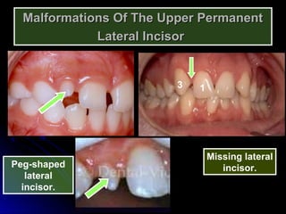 Malformations Of The Upper PermanentMalformations Of The Upper Permanent
Lateral IncisorLateral Incisor
Peg-shaped
lateral
incisor.
Missing lateral
incisor.
13
 