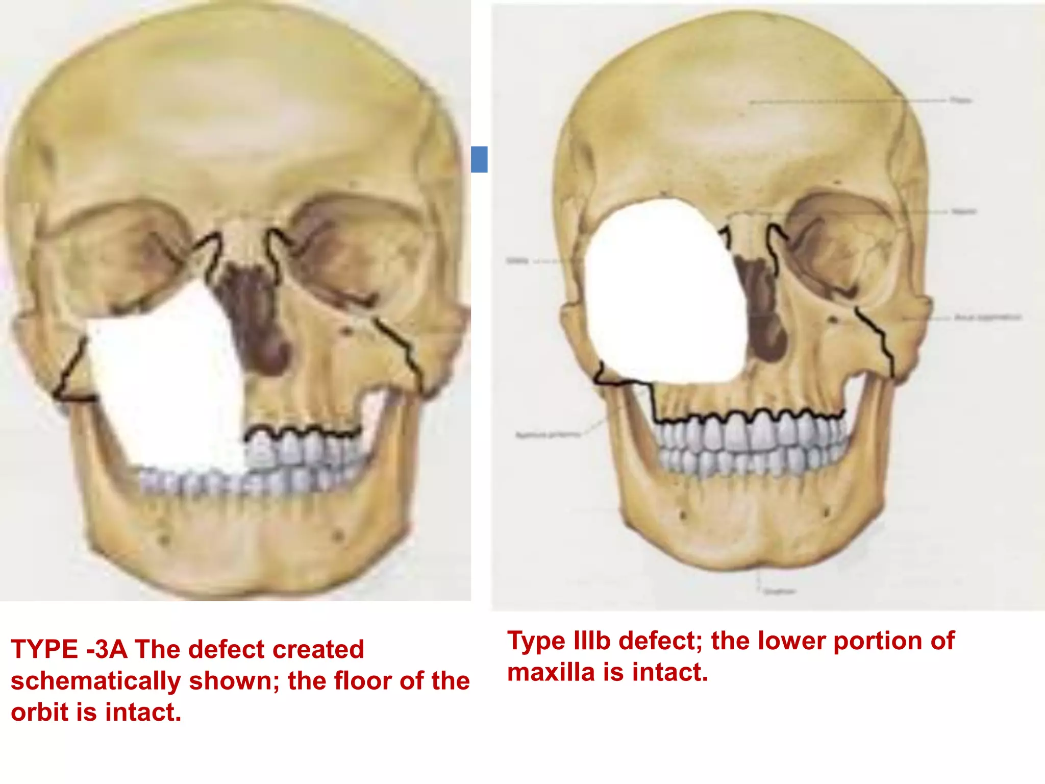 Maxillary reconstruction ih | PPTX