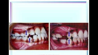 Maxillary Plane Rotation MAXILLARY ROTATION.pptx