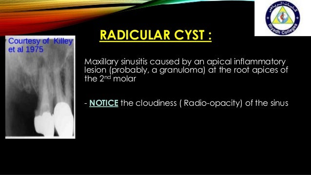 Maxillary sinus