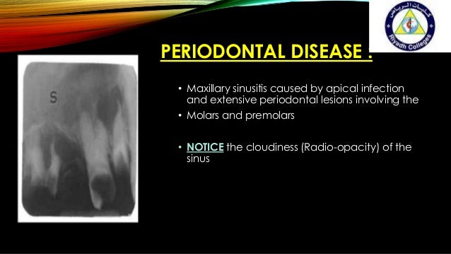 Maxillary sinus