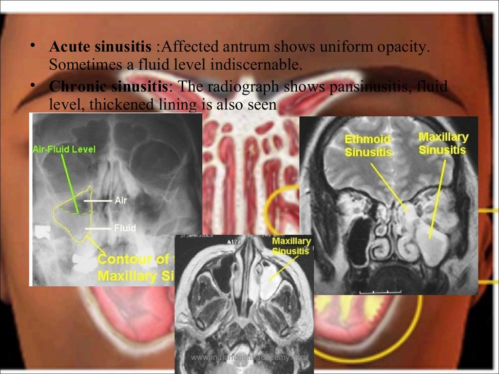Maxillary sinus /certified fixed orthodontic courses by Indian dental…
