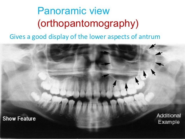 Radiology Of Maxillary Sinus