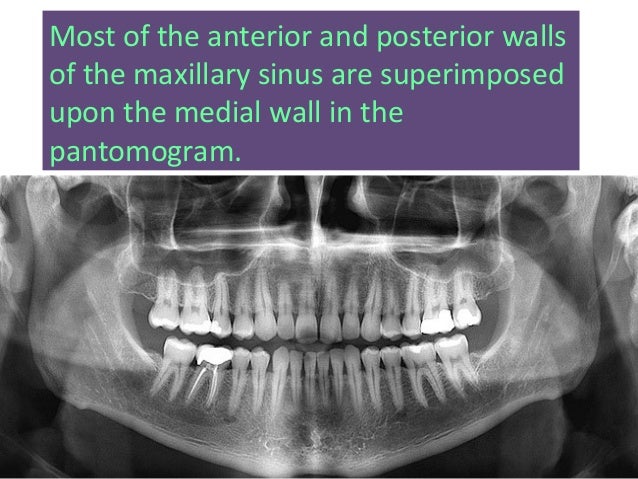 radiology of Maxillary sinus