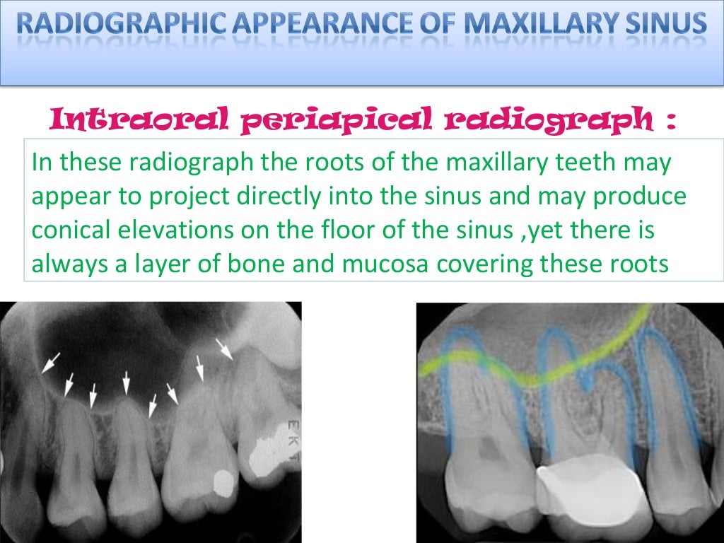 radiology of Maxillary sinus