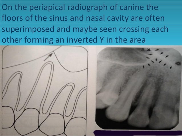 Radiology Of Maxillary Sinus