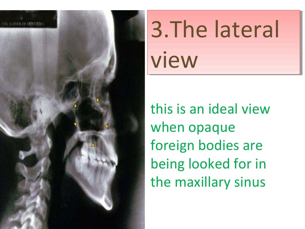 radiology of Maxillary sinus