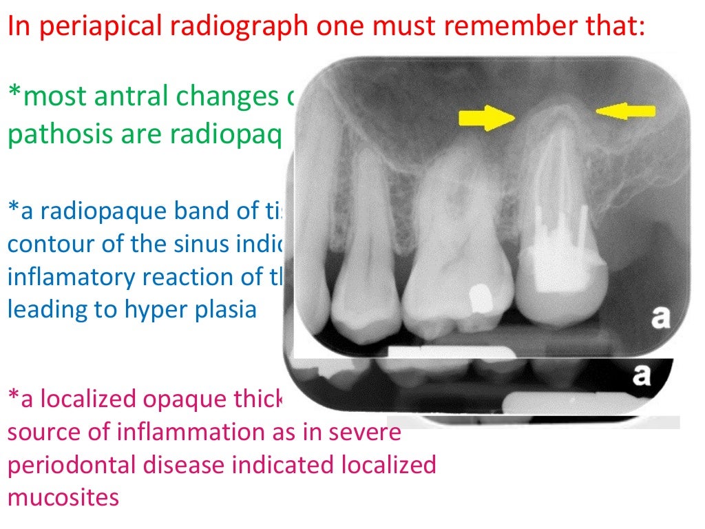 radiology of Maxillary sinus