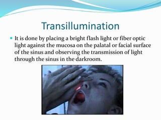 Transillumination
 It is done by placing a bright flash light or fiber optic
light against the mucosa on the palatal or facial surface
of the sinus and observing the transmission of light
through the sinus in the darkroom.
 