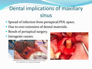 Dental implications of maxillary
sinus
 Spread of infection from periapical/PDL space.
 Due to over extension of dental materials .
 Result of periapical surgery.
 Iatrogenic causes.
 