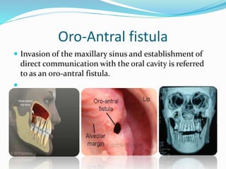 Oro-Antral fistula
 Invasion of the maxillary sinus and establishment of
direct communication with the oral cavity is referred
to as an oro-antral fistula.

 