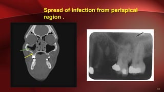 54
Spread of infection from periapical
region .
 