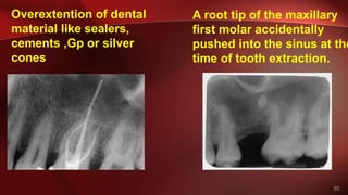 55
Overextention of dental
material like sealers,
cements ,Gp or silver
cones
A root tip of the maxillary
first molar accidentally
pushed into the sinus at the
time of tooth extraction.
 