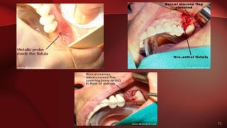 73
www.indiandentalacademy.com
 