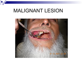 MALIGNANT LESION
 
