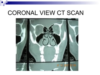 CORONAL VIEW CT SCAN
 