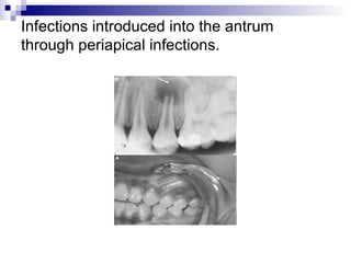 Infections introduced into the antrum
through periapical infections.
 